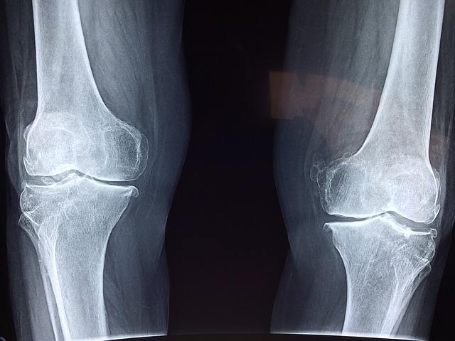 x ray image of two leg bones the bone strength